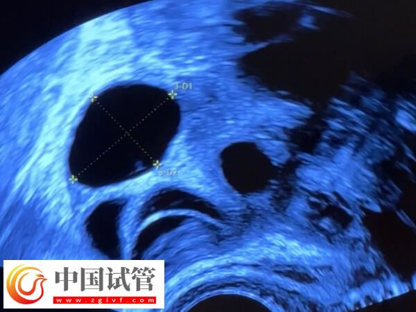 试管婴儿促排卵期间多久做一次b超监测卵泡发育?(图1) 试管婴儿促排卵期间多久做一次b超监测卵泡发育?(图1)