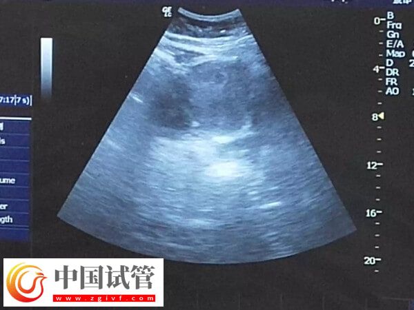 试管婴儿详细步骤一文总结,长方案助孕患者切莫错过!(图2) 试管婴儿详细步骤一文总结,长方案助孕患者切莫错过!(图2)