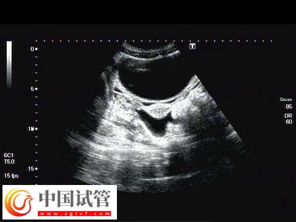 幼稚子宫无月经做试管婴儿怀孕几率低,移植难度大是其一(图1) 幼稚子宫无月经做试管婴儿怀孕几率低,移植难度大是其一(图1)