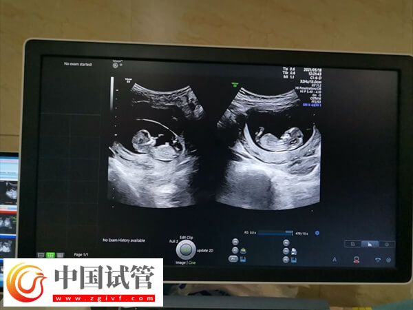 10个人做试管几个能成功(图2)