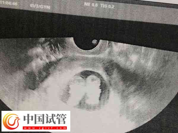 29岁试管双胎的成功率高不高(图2) 29岁试管双胎的成功率高不高(图2)