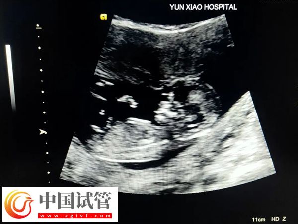 郑州市妇幼保健院试管生男女费用