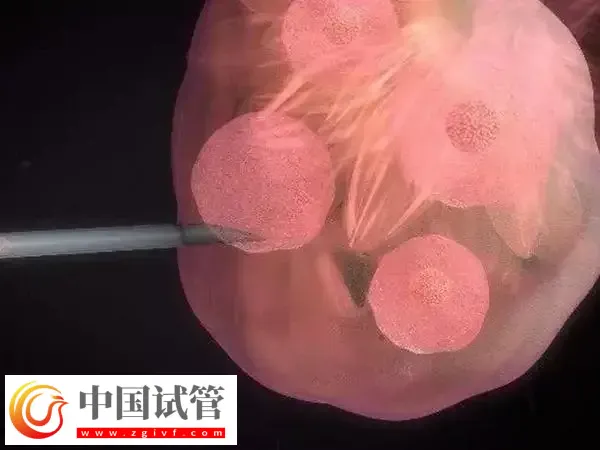 俄罗斯取卵有什么风险