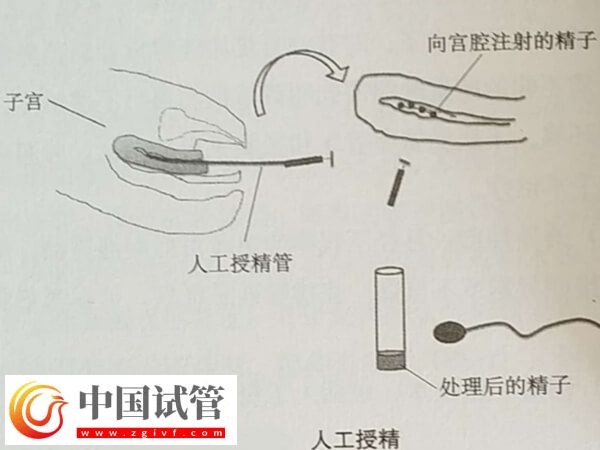 沧州人工授精多少钱一次？检查、促排卵要花多少？