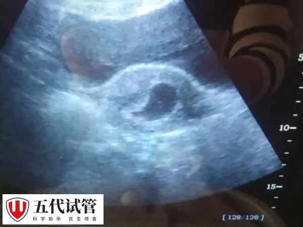 孕囊偏小要注意营养摄入